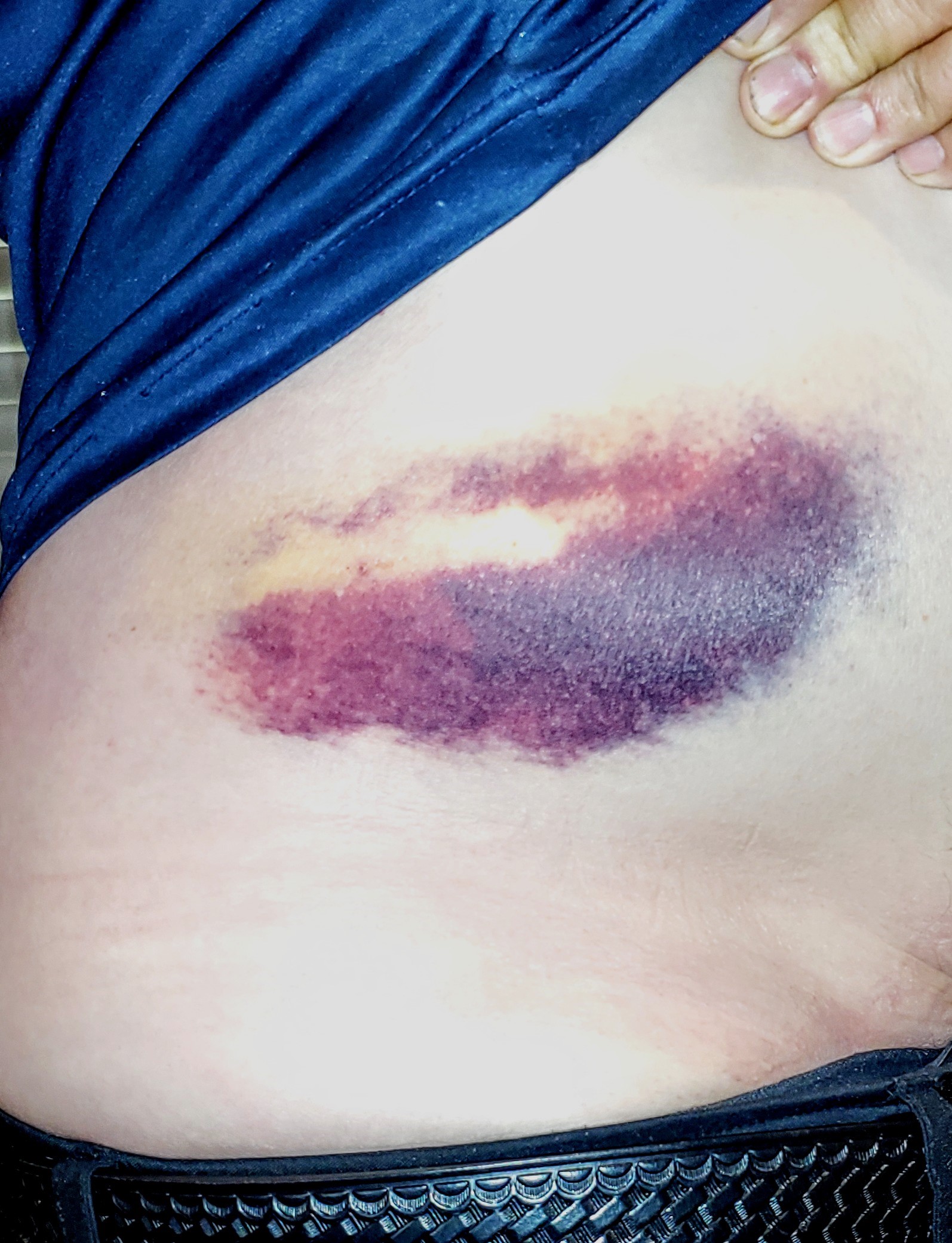 Hematoma.jpg