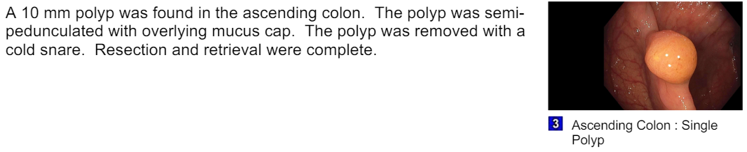 polyp.PNG